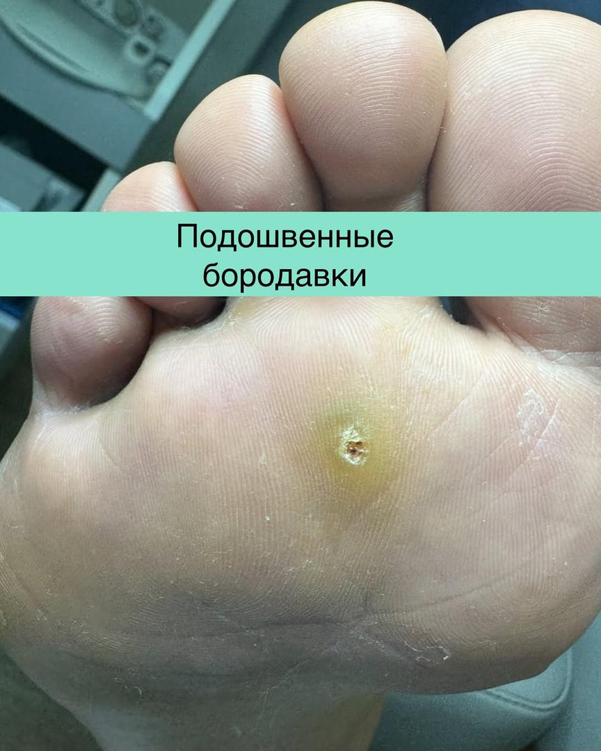 vroshiy_nogot
